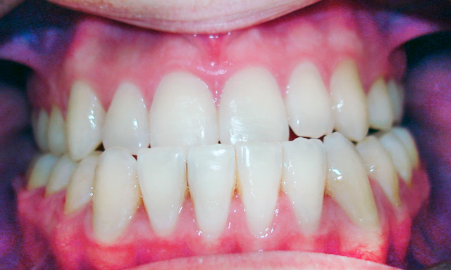 Caso 9 - Ortodontia em Adultos com Cirurgia Ortognática - antes
