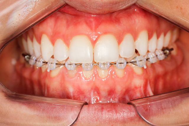 Caso 7 - Ortodontia em Adultos com Cirurgia Ortognática. - depois